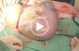 Caul Birth c-section video