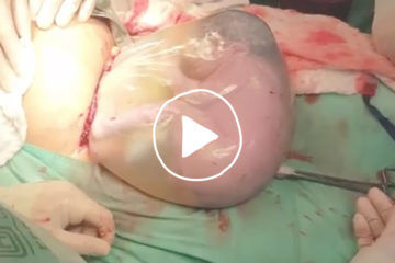 Caul Birth c-section video