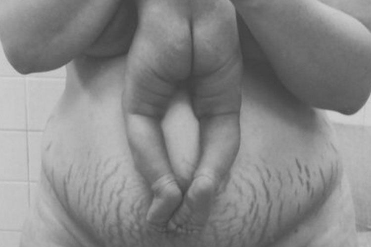 Love your stretch marks