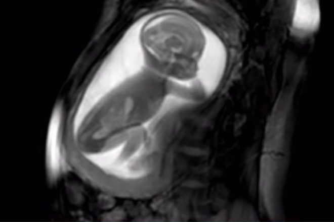 in utero MRI scan of baby swallowing