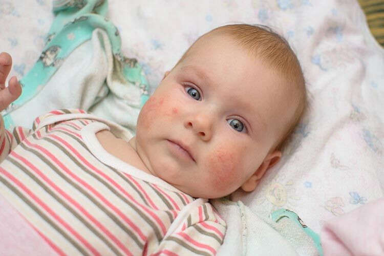 New research shows Merino wool is best for babies with eczema
