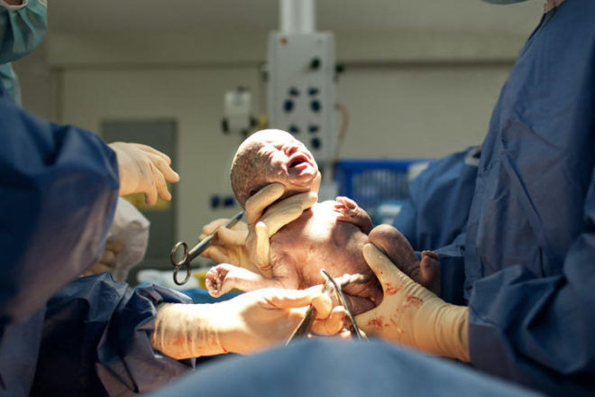 cesarean - section birth photo