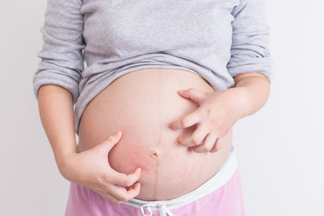 Cholestasis of pregnancy itch, scratching