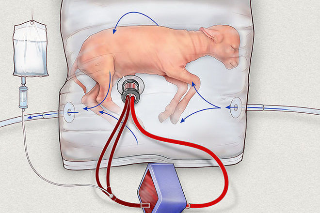 artificial womb Children's Hospital of Philadelphia