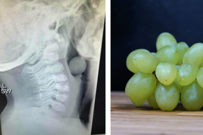 grape lodged in lungs child choking