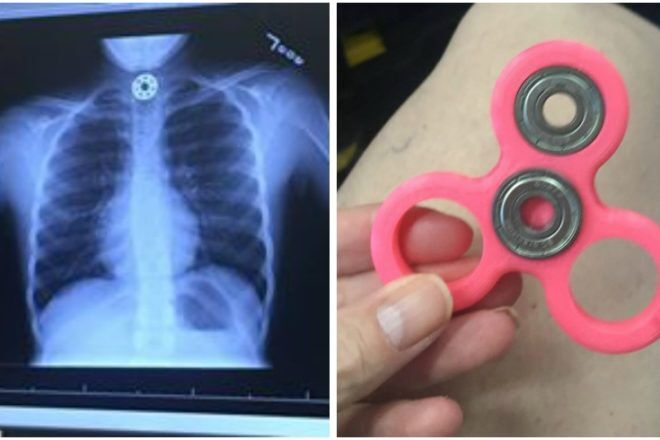 fidget spinner choking risk warning x-ray