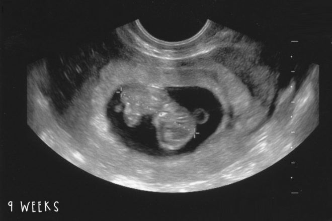 9 week baby ultrasound photo