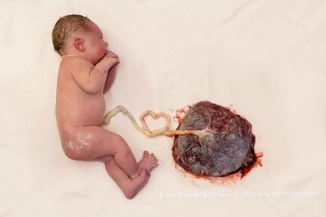 Lotus birth with placenta