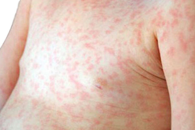 Measles symptoms on toddler