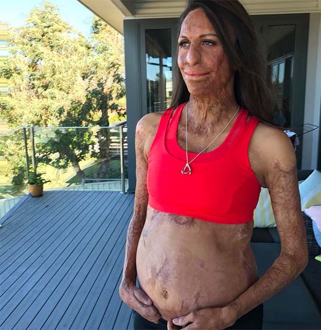 Turia Pitt shows her gorgeous baby bump