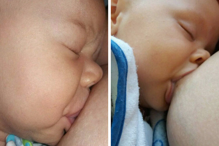 Close up of tongue tie in a newborn baby affecting breastfeeding latch