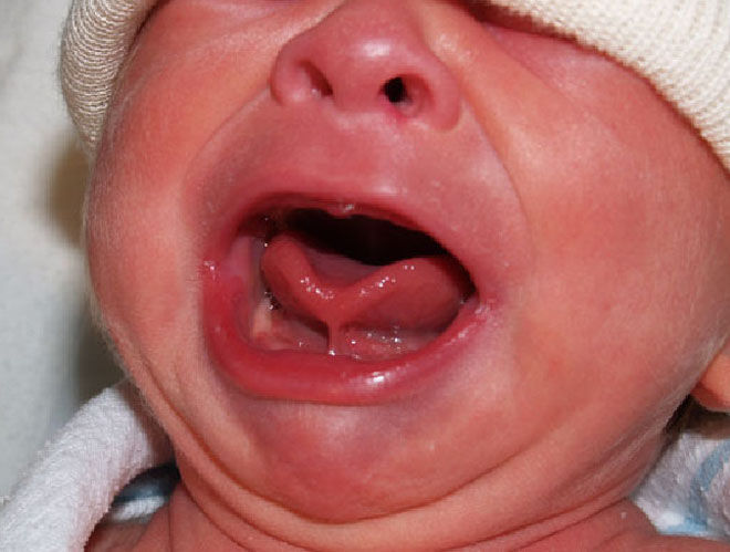 Tongue tie in baby