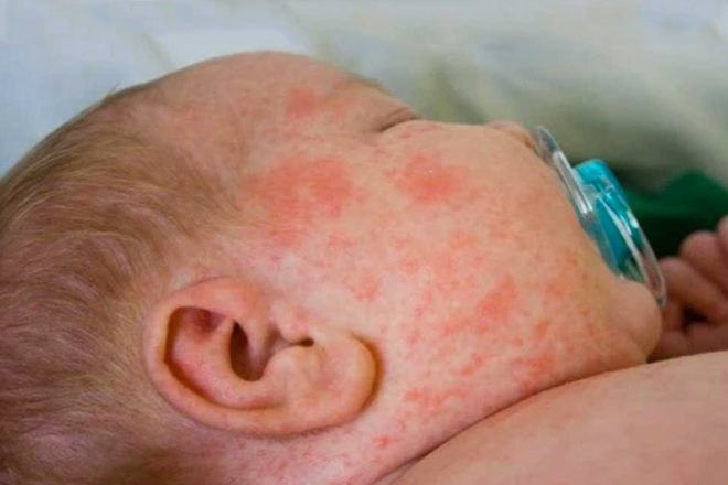 baby measles outbreak