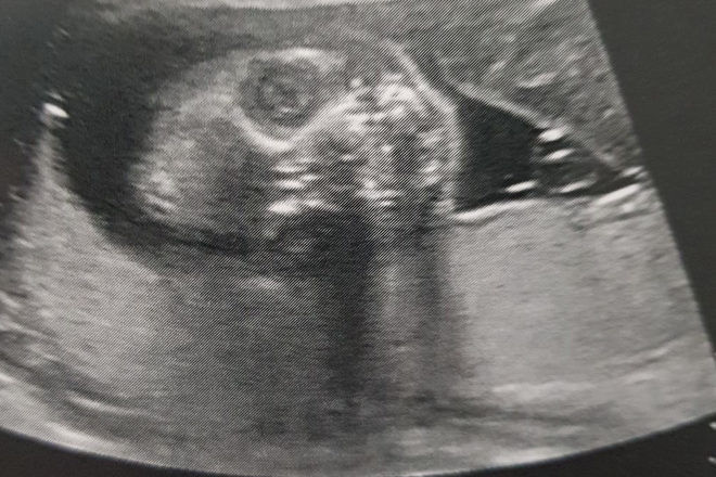 Scary ultrasound image