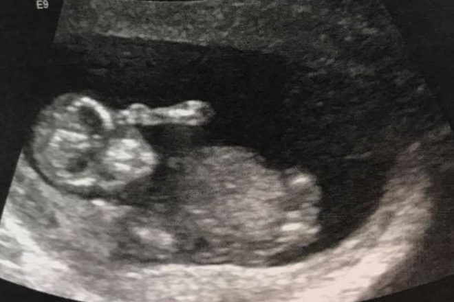 Freaky (and funny) ultrasound images