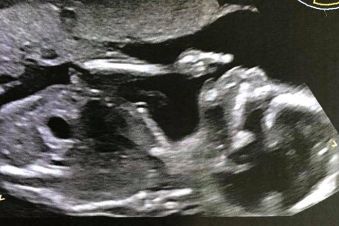Baby giving the bird in ultrasound