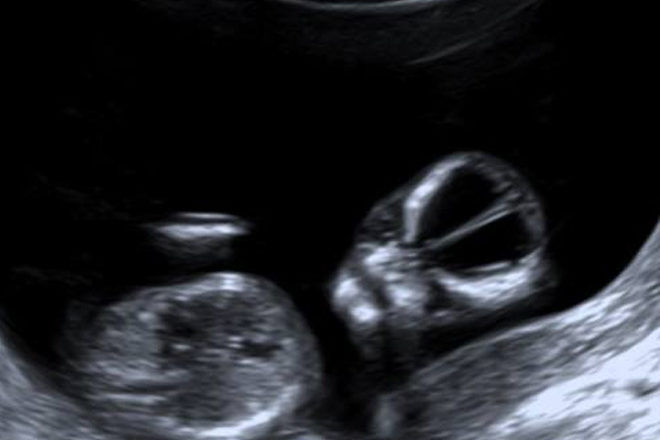 Babies looking like aliens in ultrasound images