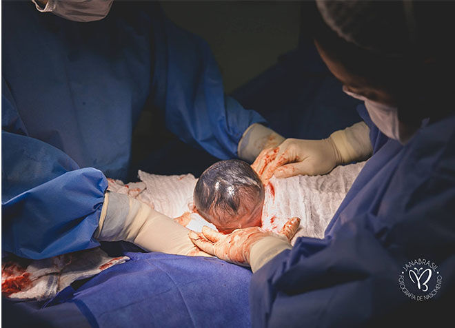 Amniotic sac c-section birth