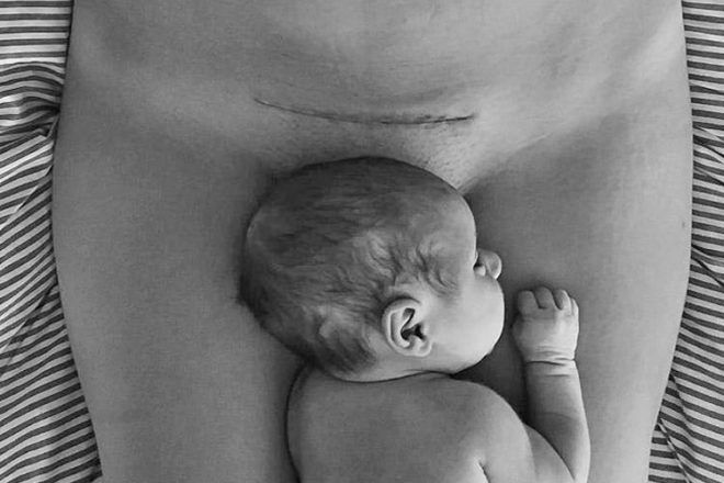 c section scar with baby on tummy