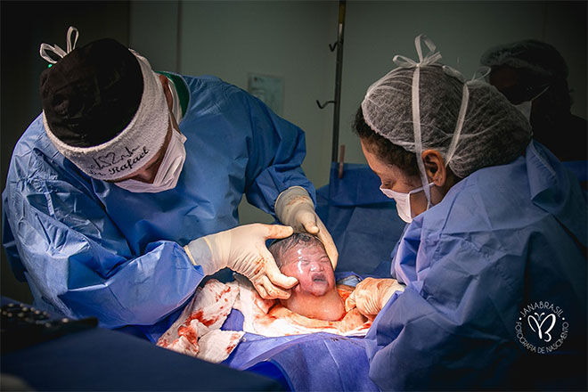 en-caul-c-section-birth