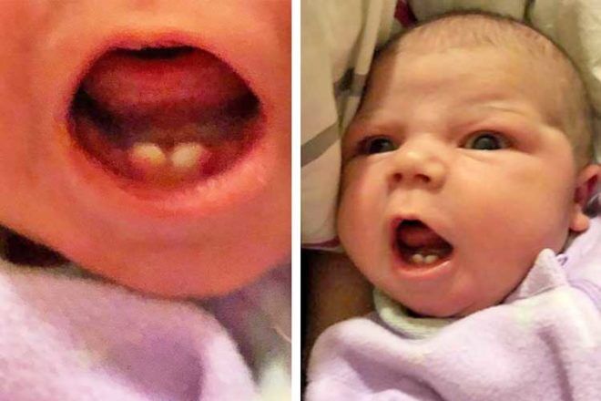 Baby born with teeth