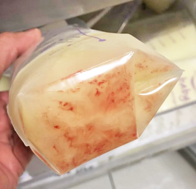 Blood in breastmilk