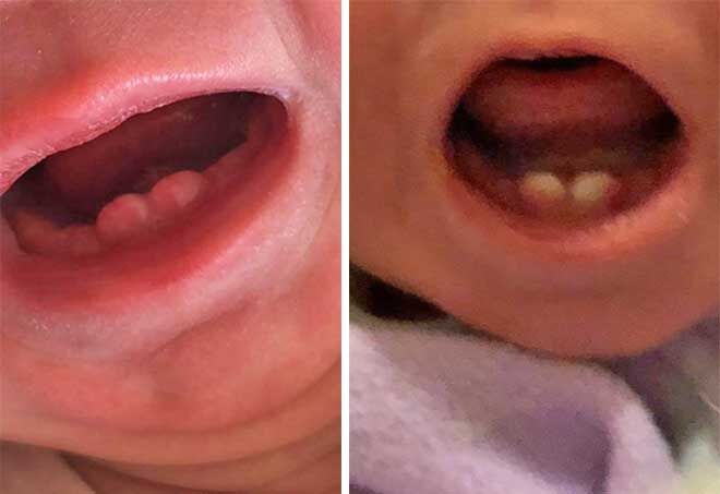 Newborn teeth