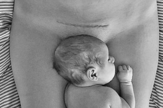 C-section scar and baby