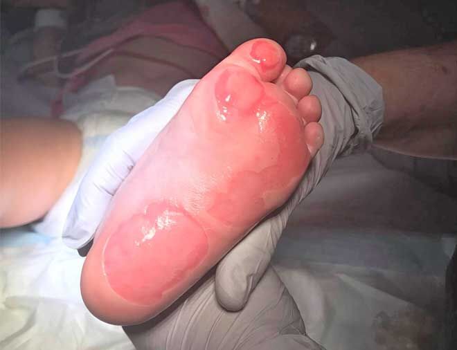 Mum's warning after toddler suffers burns