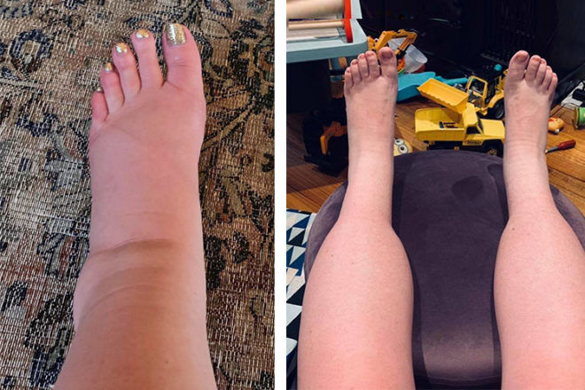 Pregnancy leg and ankle swelling