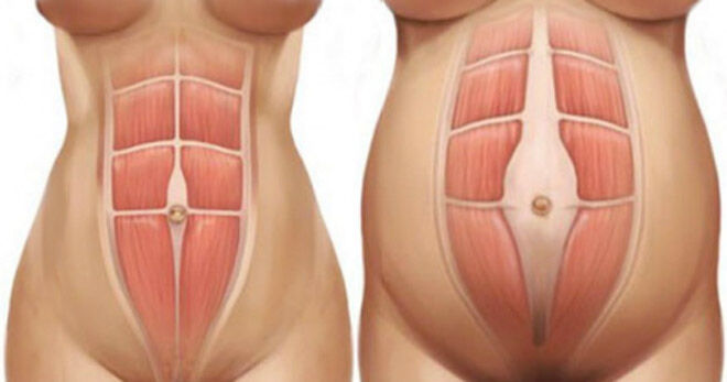 Abdominal Muscle Separation — Self Physiotherapy