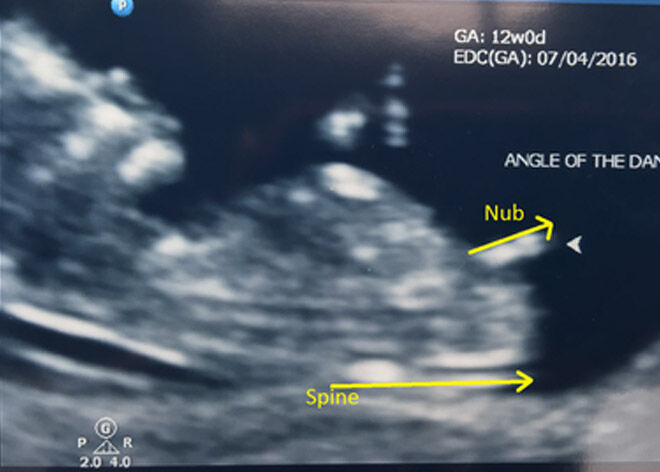 How to 'predict' baby's gender from an early ultrasound