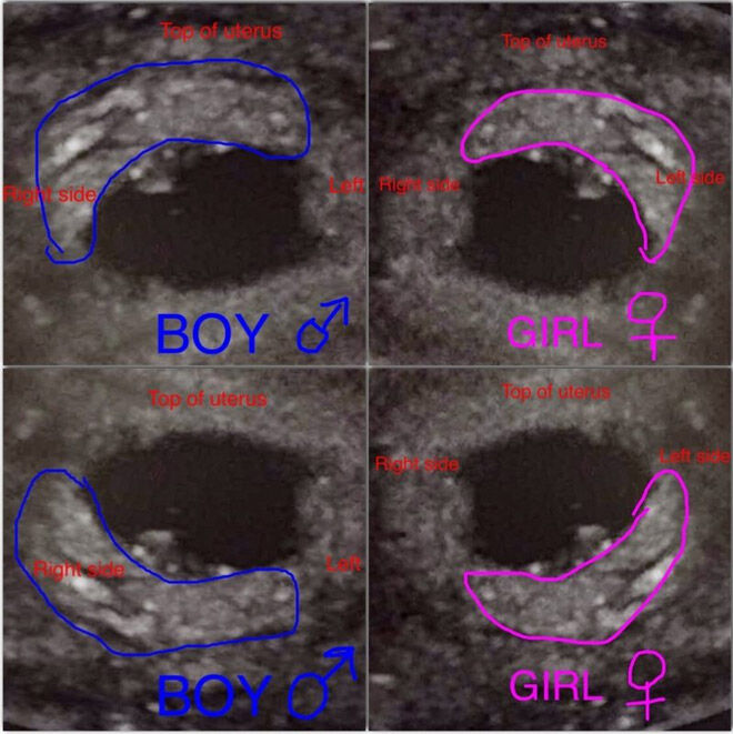 Placenta theory gender predicition