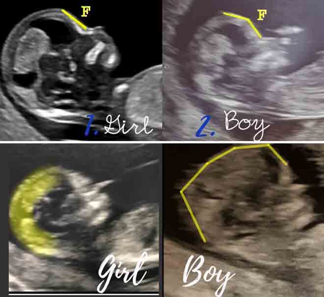 How to baby's gender from an early ultrasound