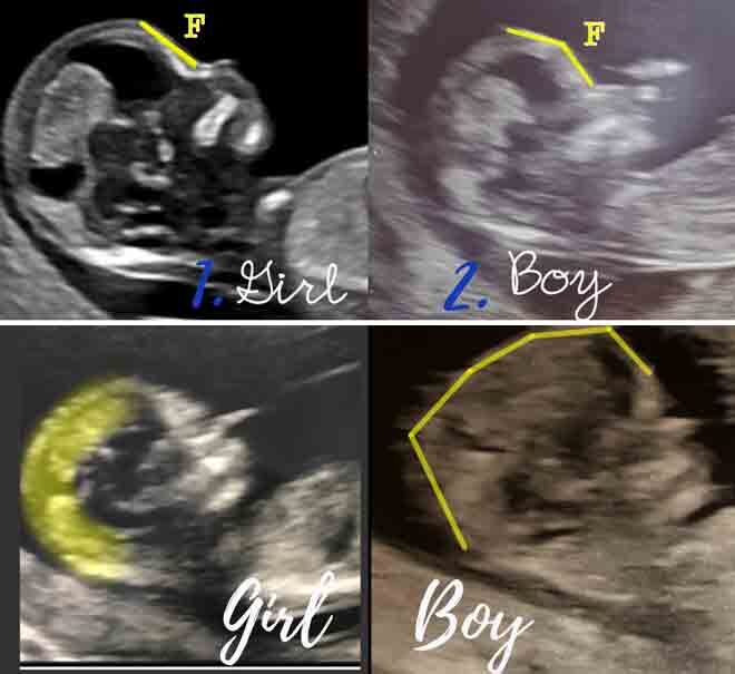 How to 'predict' baby's gender from an early ultrasound