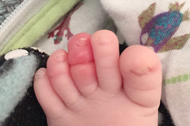 Baby toe hair tourniquet