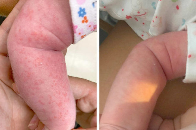 DermaGen baby before and after