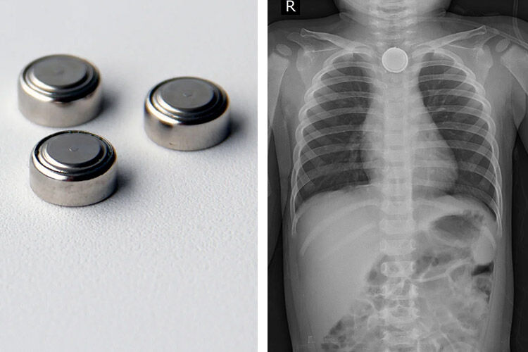 Button Battery Warning Hidden Dangers for Kids