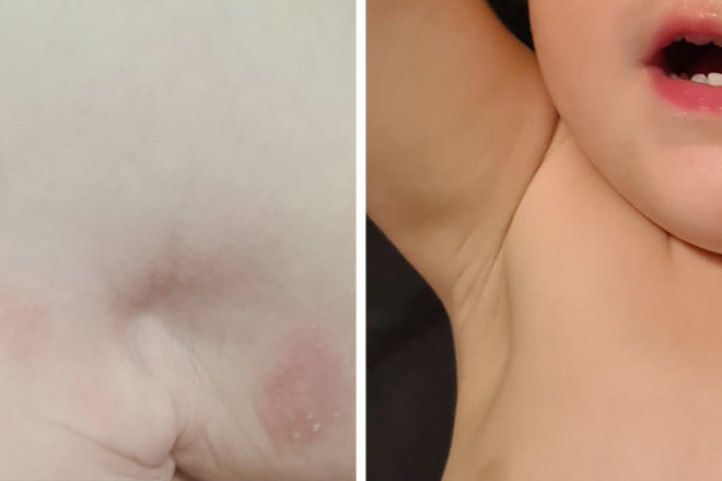 DermaGen before and after review Mindy Krug