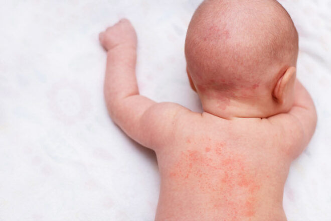 9 ways to soothe a baby with eczema | Mum's Grapevine