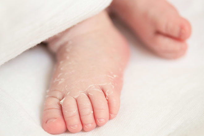 Why does newborn skin peel? | Mum's Grapevine
