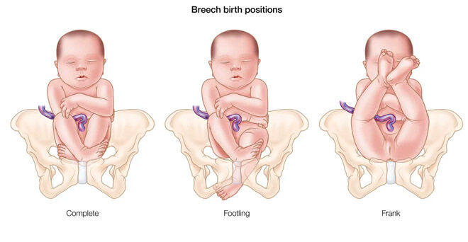 Breech birth positions