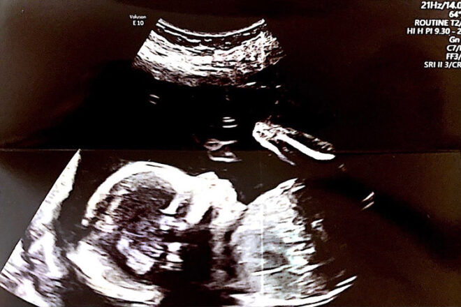 Breech birth ultrasound