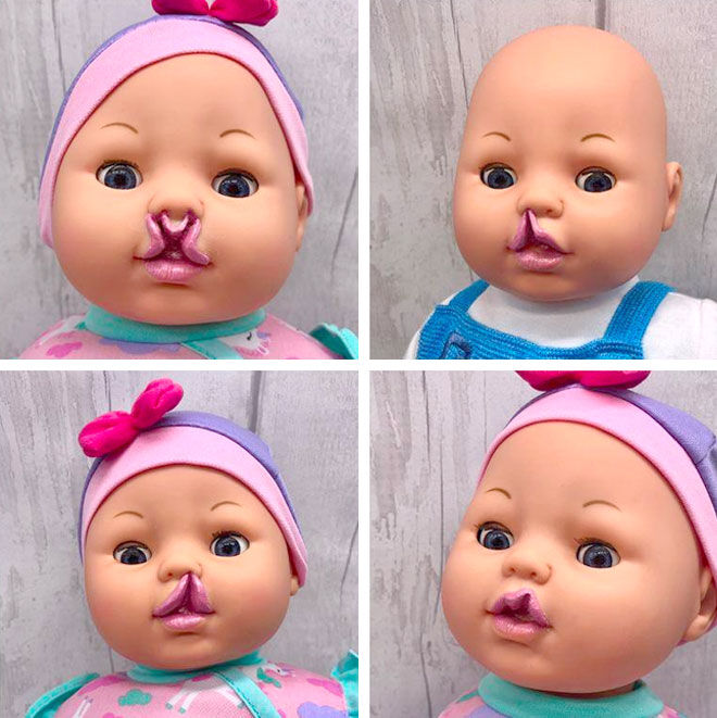 Cleft palate dolls