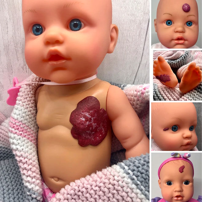 Dolls with birthmarks