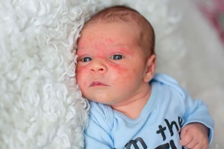 Newborn Baby Acne