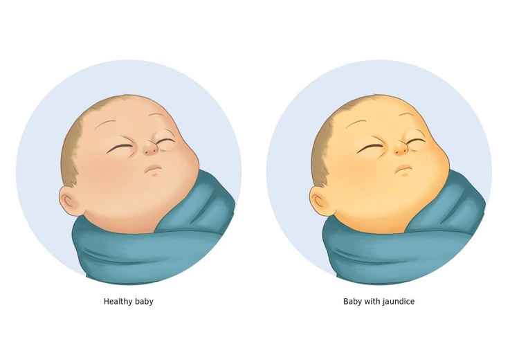Jaundice in Babies what it means and how to treat Mum's Grapevine