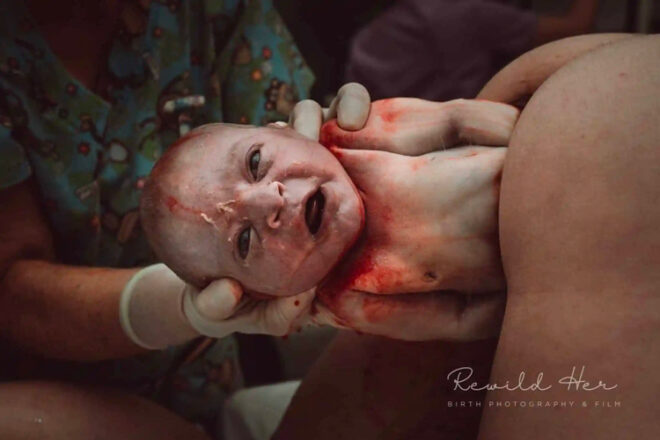 Baby being pulled out of mother during birth