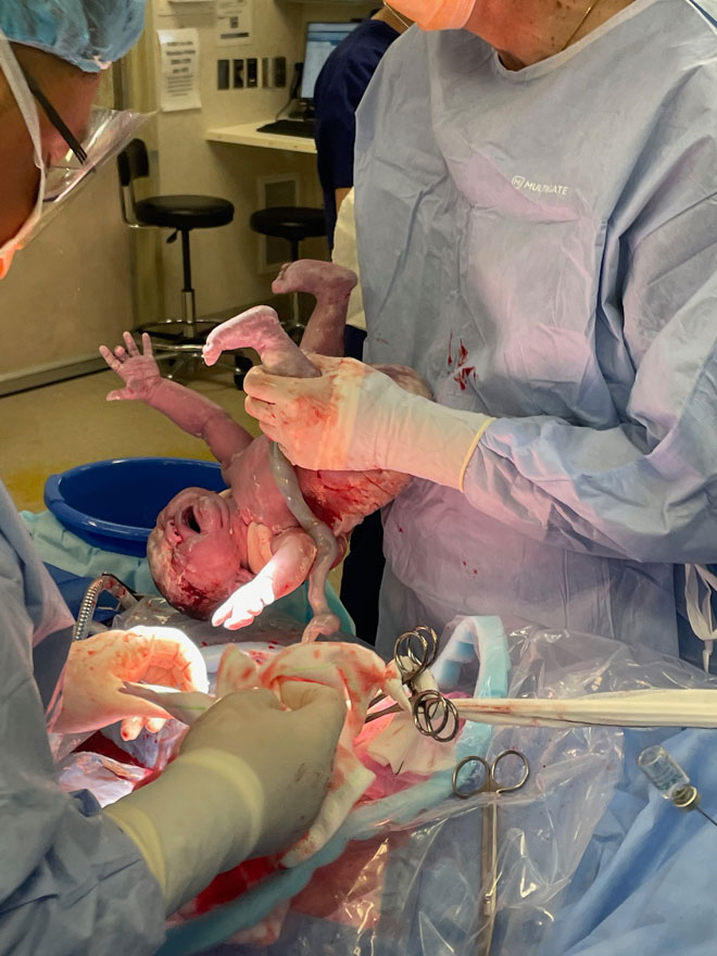 Baby Charlotte born via c-section