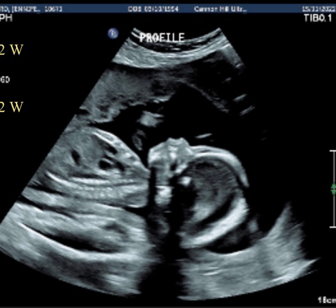 Baby Daphnie's 20 week ultrasound